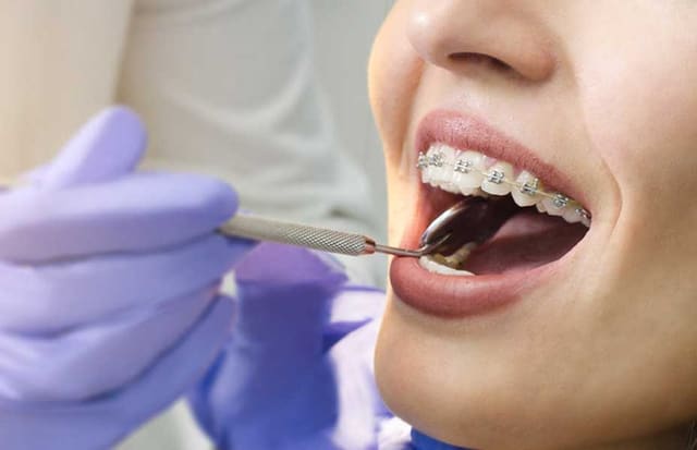 18 yaşdan sonra breketlər nə dərəcədə effektlidir? – Həkim danışır