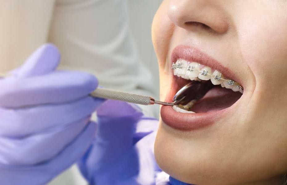 18 yaşdan sonra breketlər nə dərəcədə effektlidir? – Həkim danışır