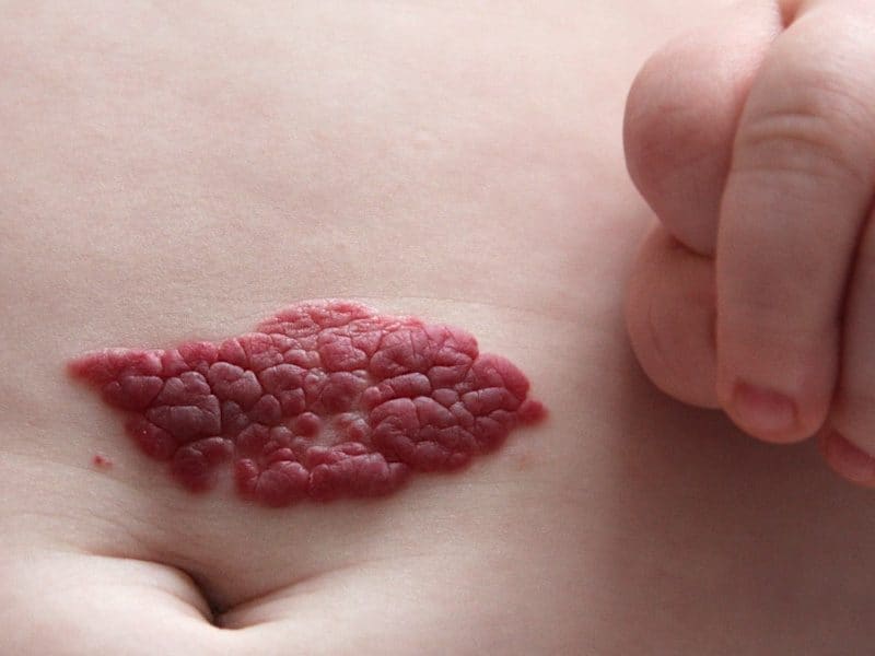 Hemangioma nə zaman müalicə tələb edir?