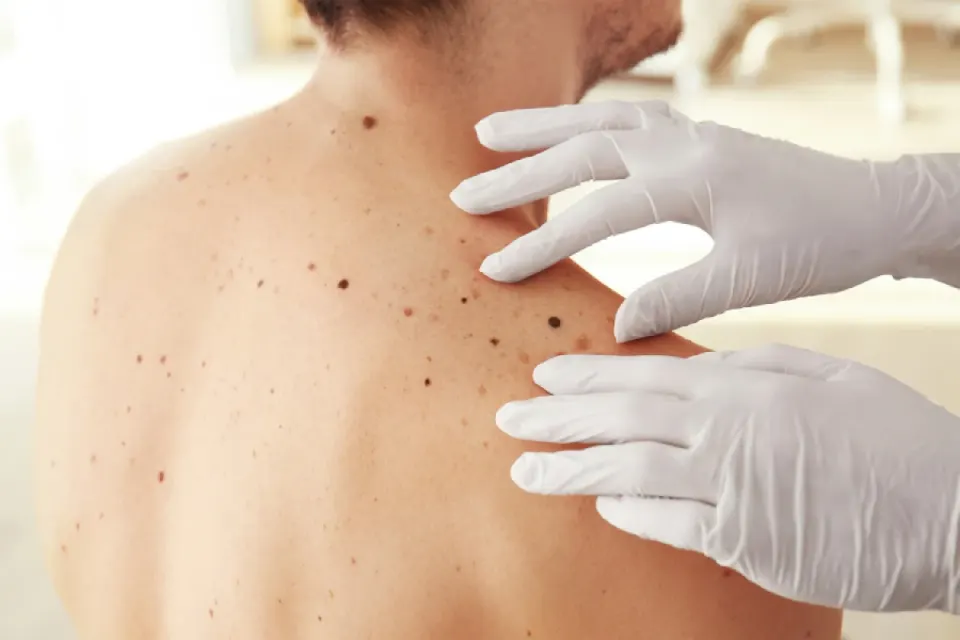 Cuba develops drug to treat skin cancer