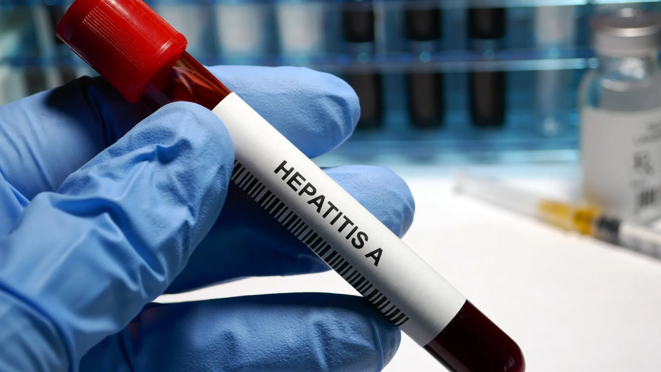 Ötən il Hepatit A infeksiyasına yoluxma halları azalıb