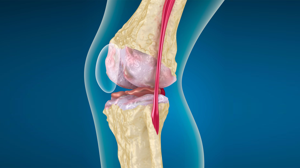 Qonartrozun yaranma səbəbi nədir? - Həkim danışır