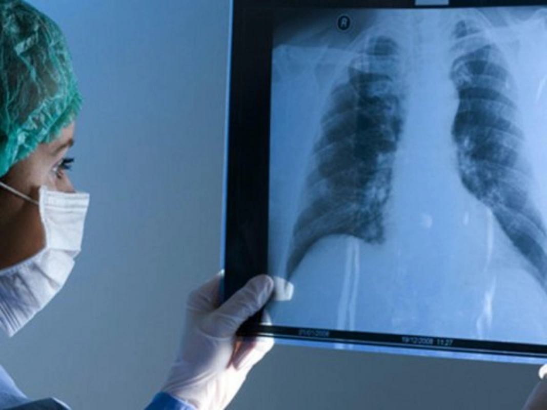 Ölkə üzrə 3500-dən çox vərəmli xəstə dispanser qeydiyyatına alınıb