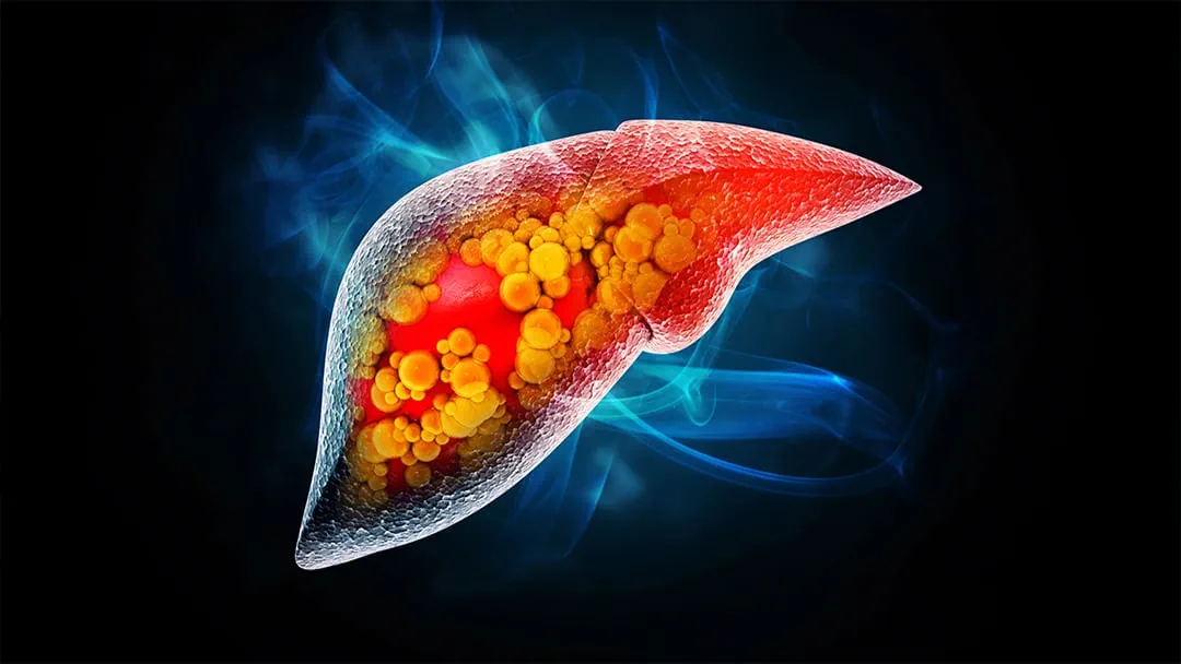 Qaraciyər piylənməsinin qarşısını necə almaq olar? - Həkim məsləhəti