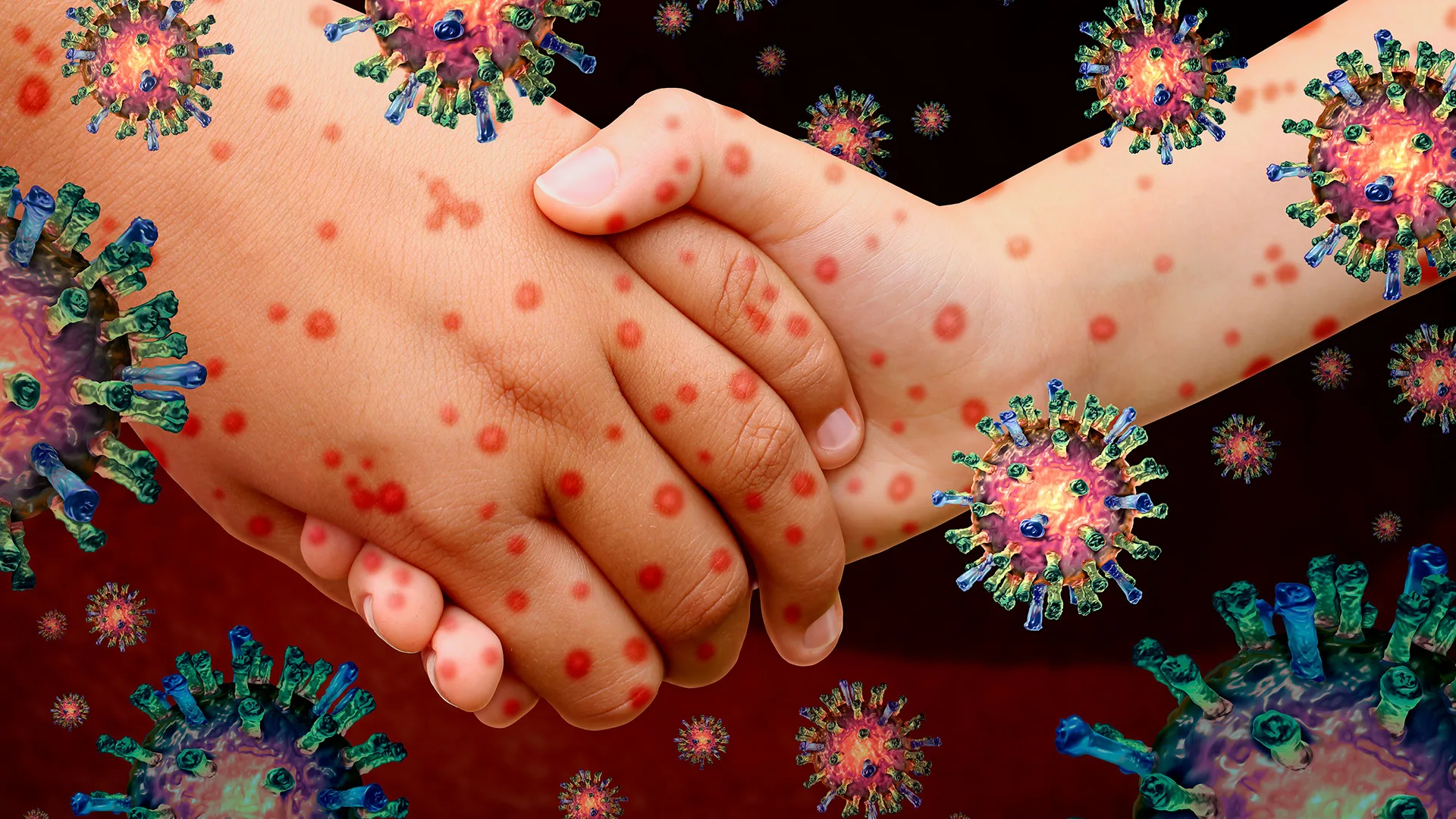 Monqolustanda qızılca xəstəliyinə yoluxanların sayı 14 mini keçib