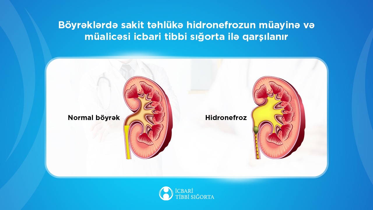 Böyrəklərdə hidronefrozun müayinə və müalicəsi  icbari tibbi sığorta ilə qarşılanır