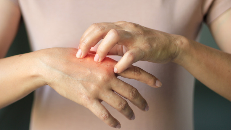 Dəridə baş verən dəyişikliklər hansı xəstəlikdən xəbər verə bilər? - Həkim danışır