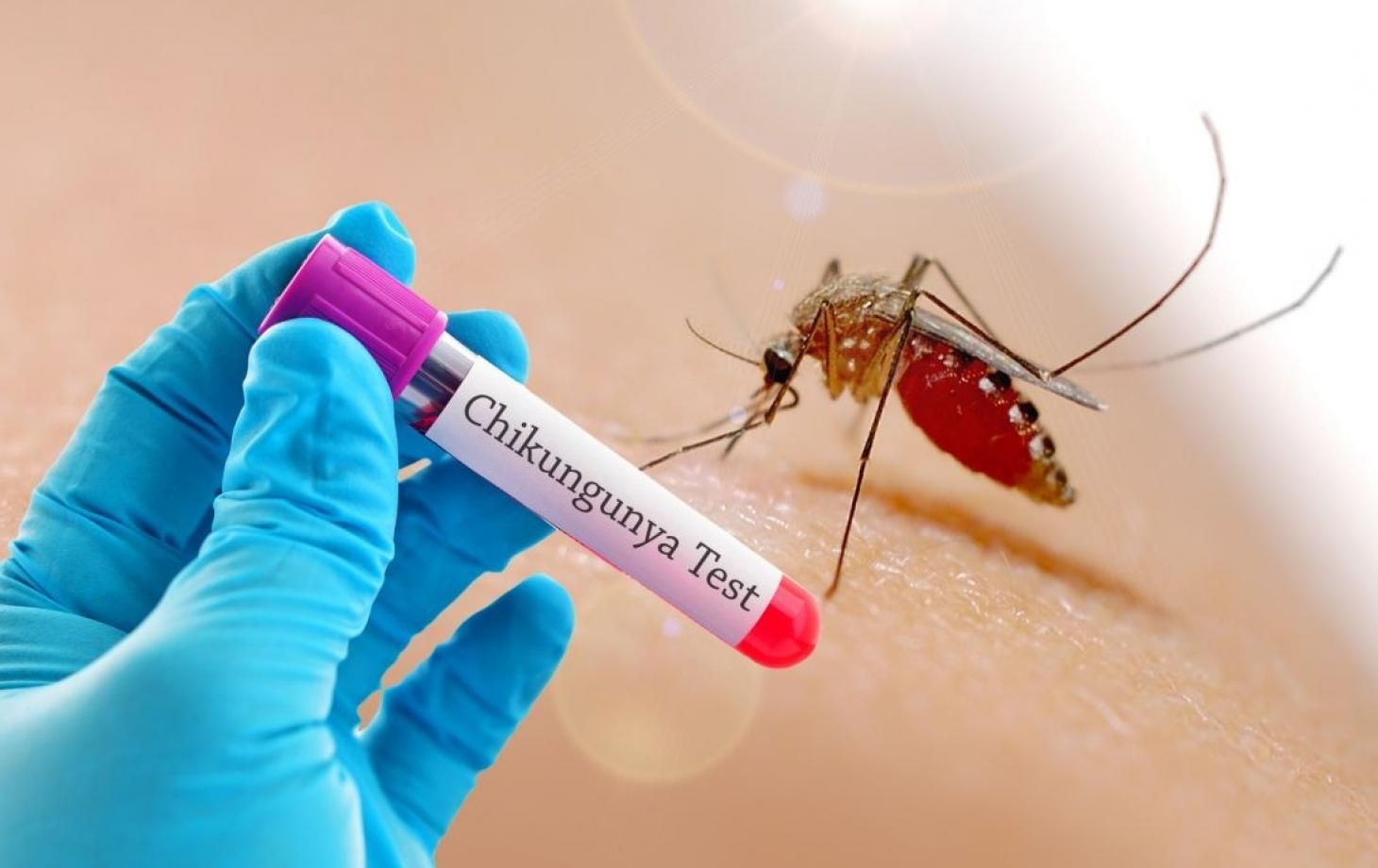 Ermənistanda ilk çikunqunya qızdırması hadisəsi qeydə alınıb