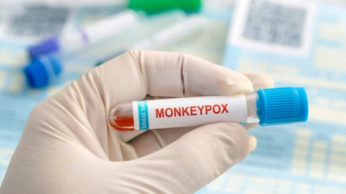 Rusiyada meymunçiçəyi virusuna yoluxma qeydə alınıb