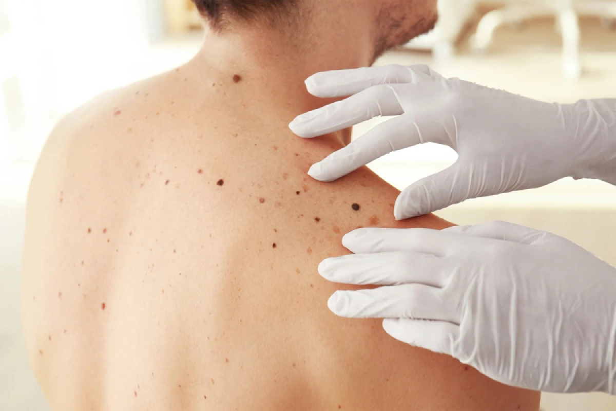 Cuba develops drug to treat skin cancer